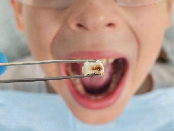 Best Emergency Treatment for Dental Infections or Abscesses in Gardnerville Ranchos, NV